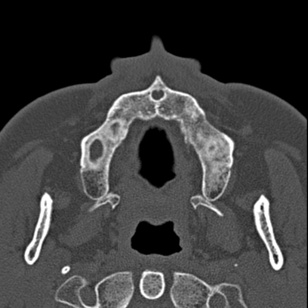 Chronic maxillary sinusitis (Radiopaedia 27879-28116 Axial bone window 4).jpg