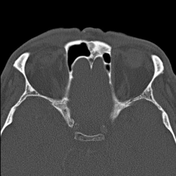 Chronic maxillary sinusitis (Radiopaedia 27879-28116 Axial bone window 41).jpg