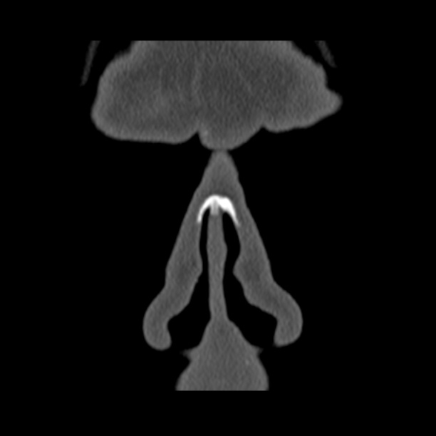 Chronic maxillary sinusitis (Radiopaedia 27879-28116 Coronal bone window 1).jpg