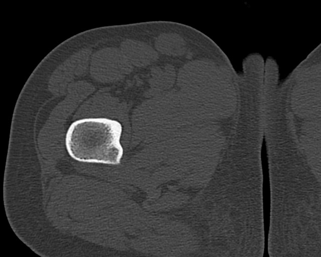 Chronic ostemyelitis of the femur with long sinus tract (Radiopaedia 74947-85982 Axial bone window 28).jpg