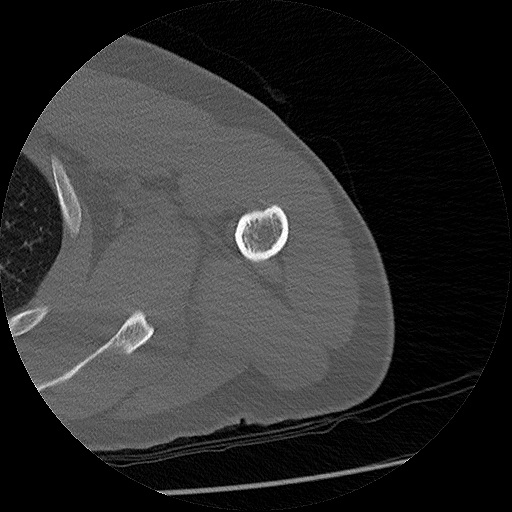 Chronic osteomyelitis (Radiopaedia 67597-76998 Axial bone window 13).jpg