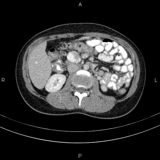 Chronic pancreatitis (Radiopaedia 64576-73450 C 75).jpg