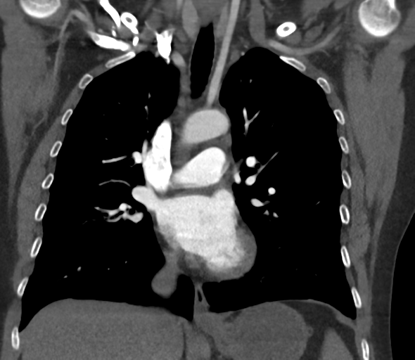 Chronic pulmonary embolus (Radiopaedia 39129-41341 Coronal C+ CTPA 43).png