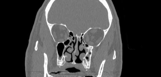 File:Chronic sphenoidal sinusitis (Radiopaedia 62030-70122 Coronal bone window 74).jpg