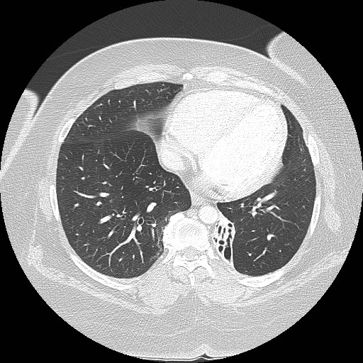 Cicatrisation collapse (Radiopaedia 17405-17089 lung window 74).jpg