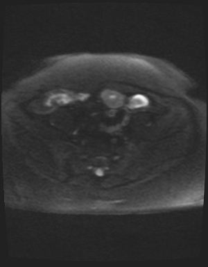 Class II Mullerian duct anomaly- unicornuate uterus with rudimentary horn and non-communicating cavity (Radiopaedia 39441-41755 Axial DWI 38).jpg
