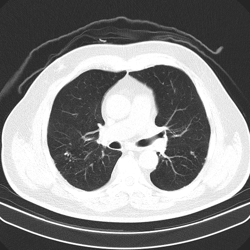 File:Classic complicated silicosis (Radiopaedia 49720-54961 Axial lung window 25).jpg