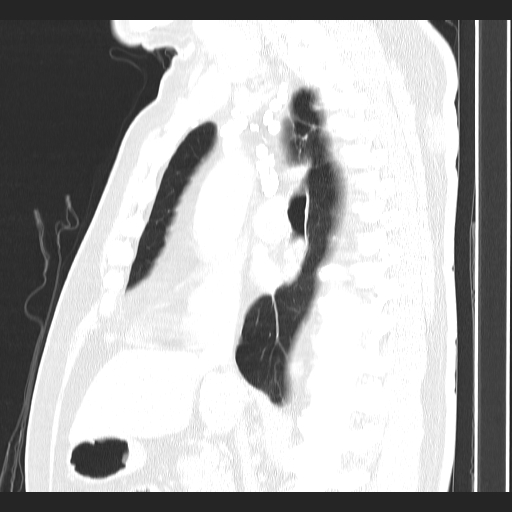 File:Classic complicated silicosis (Radiopaedia 49720-54961 Sagittal lung window 35).jpg
