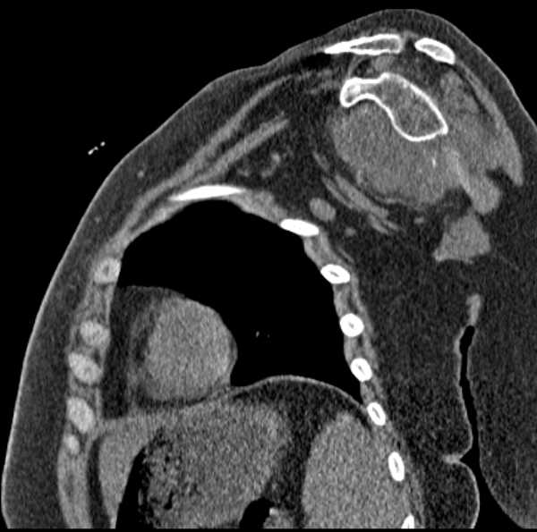 File:Clear cell chondrosarcoma - humerus (Radiopaedia 63104-71612 D 36).jpg