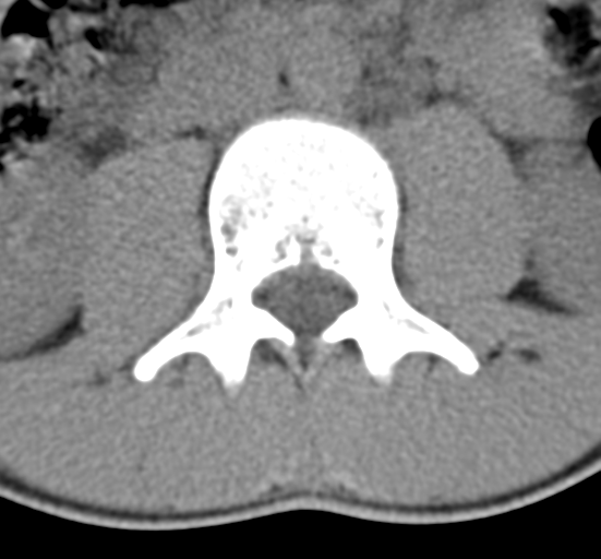File:Clear cell meningoma - lumbar spine (Radiopaedia 60116-67691 Axial non-contrast 27).png