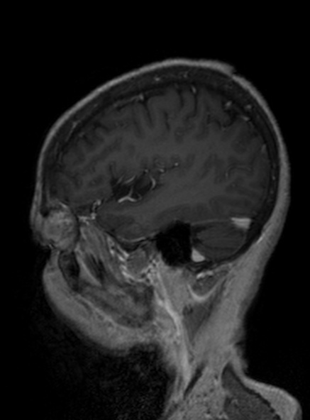 Clival meningioma (Radiopaedia 53278-59248 Sagittal T1 C+ 337).jpg