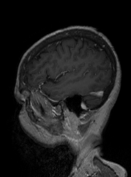 Clival meningioma (Radiopaedia 53278-59248 Sagittal T1 C+ 343).jpg