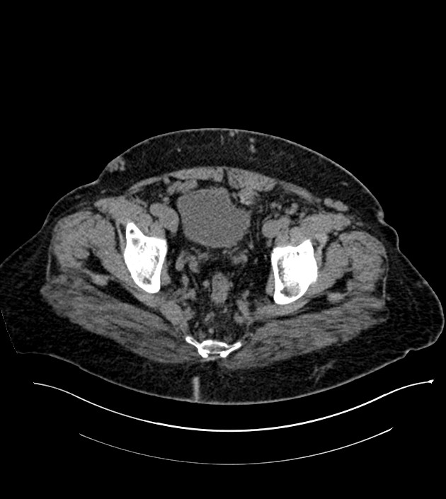 Closed-loop small bowel obstruction-internal hernia (Radiopaedia 78439-91096 Axial non-contrast 139).jpg