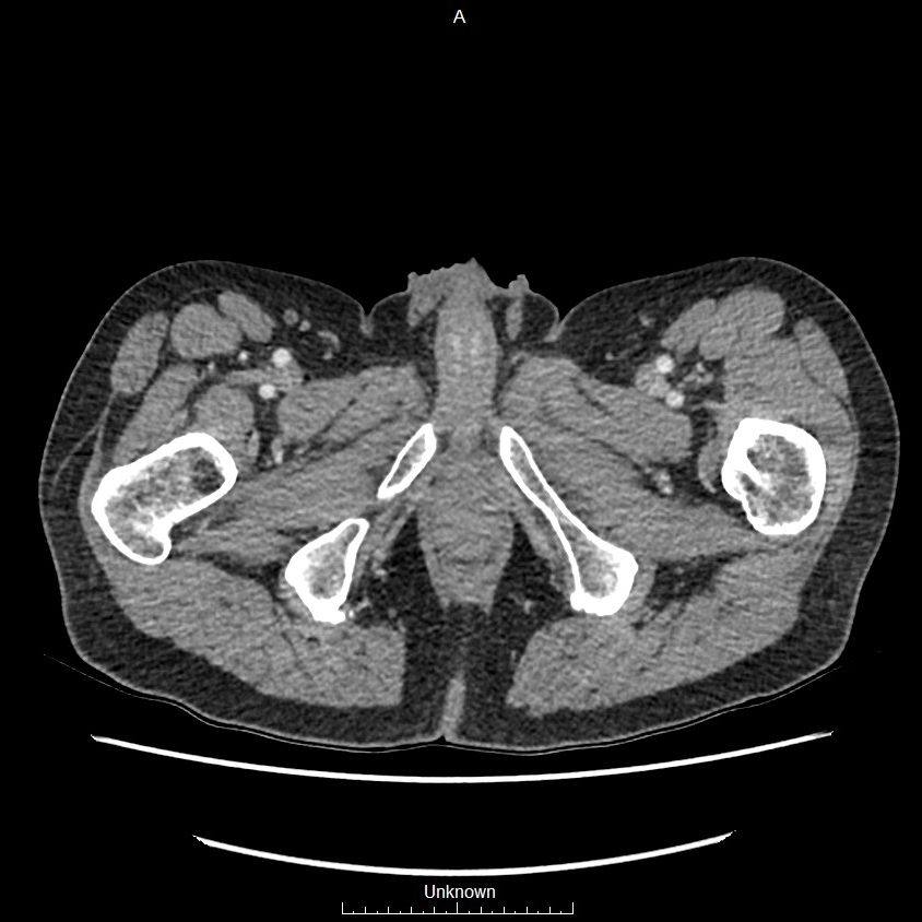 Closed loop bowel obstruction and ischemia (Radiopaedia 86959-103180 A 97).jpg