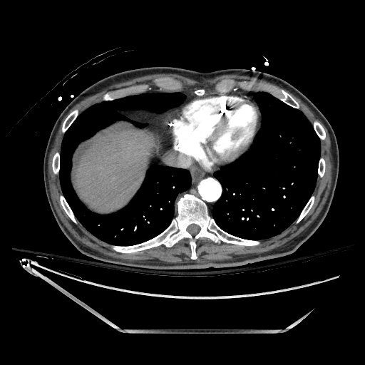 File:Closed loop obstruction due to adhesive band, resulting in small bowel ischemia and resection (Radiopaedia 83835-99023 B 17).jpg