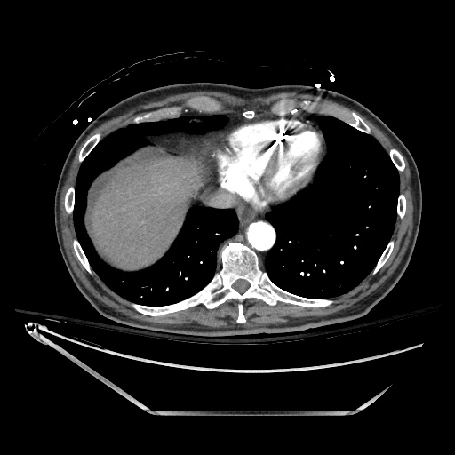 File:Closed loop obstruction due to adhesive band, resulting in small bowel ischemia and resection (Radiopaedia 83835-99023 B 18).jpg