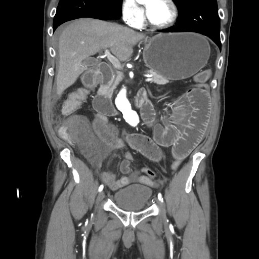 File:Closed loop obstruction due to adhesive band, resulting in small bowel ischemia and resection (Radiopaedia 83835-99023 C 56).jpg