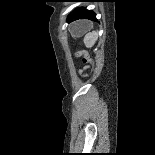File:Closed loop small bowel obstruction (Radiopaedia 65403-74451 C 101).jpg