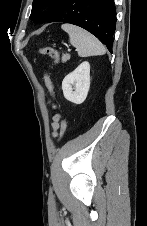 Closed loop small bowel obstruction - internal hernia (Radiopaedia 57806-64778 C 26).jpg