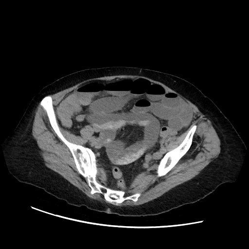 Closed loop small bowel obstruction due to adhesive band, with intramural hemorrhage and ischemia (Radiopaedia 83831-99017 Axial non-contrast 123).jpg