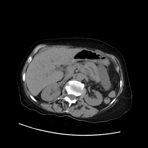 File:Closed loop small bowel obstruction due to adhesive band, with intramural hemorrhage and ischemia (Radiopaedia 83831-99017 Axial non-contrast 59).jpg