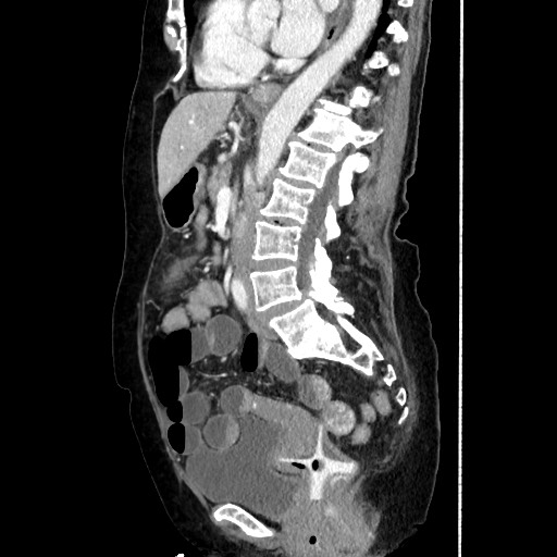 Closed loop small bowel obstruction due to adhesive band, with intramural hemorrhage and ischemia (Radiopaedia 83831-99017 D 107).jpg