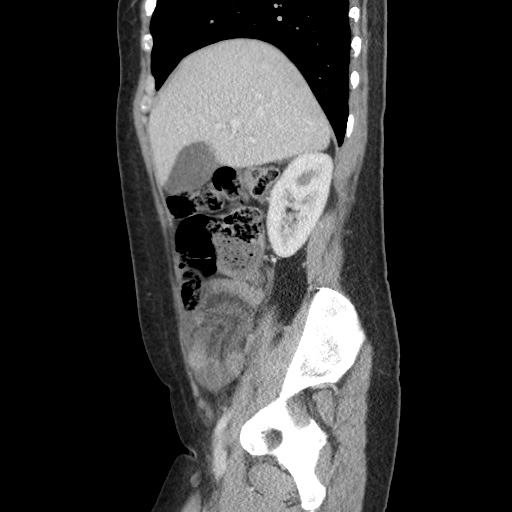 File:Closed loop small bowel obstruction due to trans-omental herniation (Radiopaedia 35593-37109 C 20).jpg