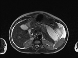 File:Closed loop small bowel obstruction in pregnancy (MRI) (Radiopaedia 87637-104031 Axial T2 20).jpg