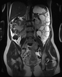 File:Closed loop small bowel obstruction in pregnancy (MRI) (Radiopaedia 87637-104031 Coronal T2 35).jpg