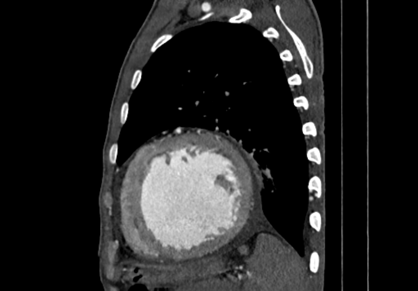 Coarctation of aorta with aortic valve stenosis (Radiopaedia 70463-80574 B 165).jpg