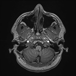 Cochlear incomplete partition type III associated with hypothalamic hamartoma (Radiopaedia 88756-105498 Axial T1 42).jpg