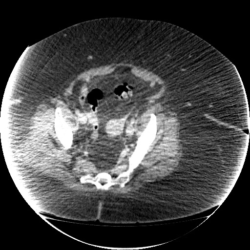File:Collection due to leak after sleeve gastrectomy (Radiopaedia 55504-61972 A 68).jpg