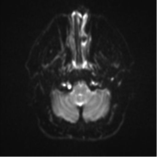 File:Colloid cyst (Radiopaedia 53164-59125 Axial DWI 4).png