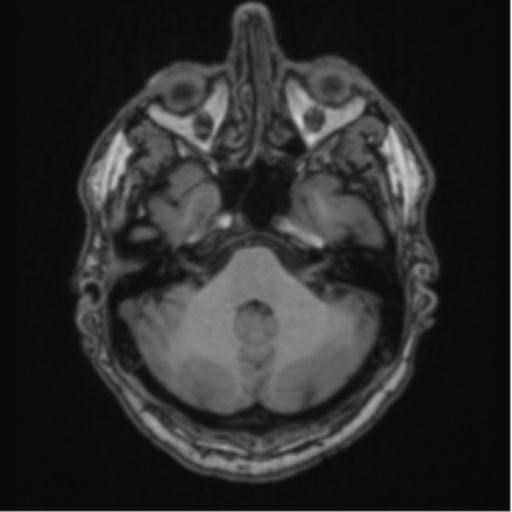 File:Colloid cyst of the third ventricle (Radiopaedia 86571-102662 Axial T1 21).png