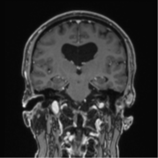 File:Colloid cyst of the third ventricle (Radiopaedia 86571-102662 Coronal T1 C+ 46).png