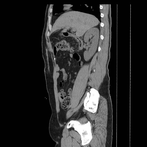 File:Colocutaneous fistula in Crohn's disease (Radiopaedia 29586-30093 C 10).jpg