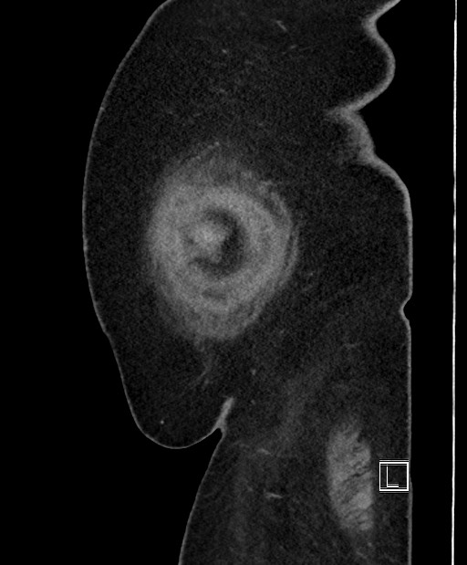 Colon adenocarcinoma (Radiopaedia 59374-66735 C 63).jpg