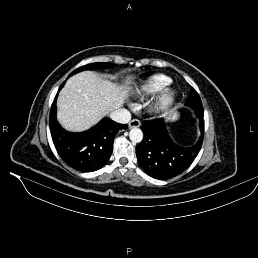 Colon adenocarcinoma (Radiopaedia 91240-108842 A 8).jpg