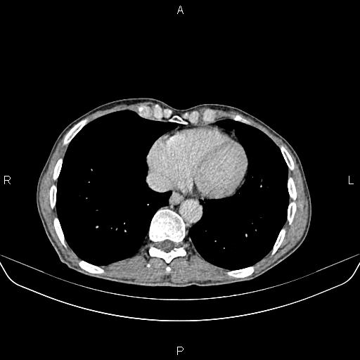 File:Colon adenocarcinoma - hepatic flexure (Radiopaedia 85635-101395 Axial C+ delayed 3).jpg