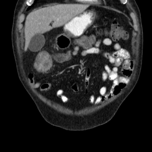 File:Colon cancer with duodenal invasion (Radiopaedia 16278-15958 B 12).jpg