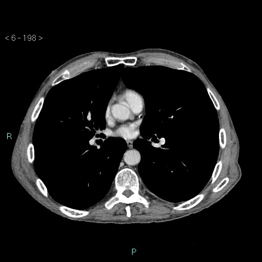 File:Colonic cancer (ultrasound and TC imaging) (Radiopaedia 50346-55713 B 198).jpg