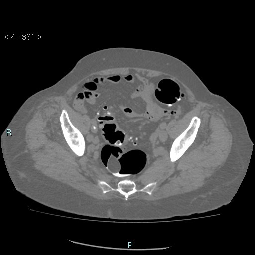 Colonic lipomas (Radiopaedia 49137-54244 Axial bone window 169).jpg