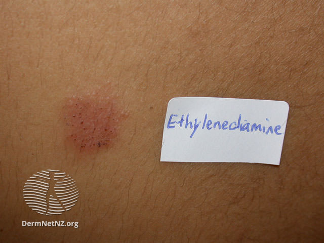 File:Contact dermatitis to ethylenediamine (DermNet NZ dermatitis-ethdiam3).jpg