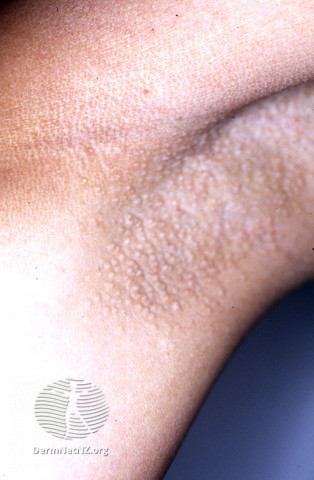 File:Fox-Fordyce disease (DermNet NZ hair-nails-sweat-fox-fordyce1).jpg