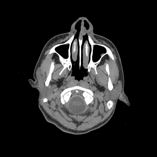Nasal pyogenic granuloma (lobular capillary hemangioma) (Radiopaedia 85536-101244 Axial non-contrast 18).jpg