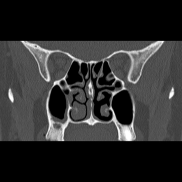 File:Nasal septal perforation (Radiopaedia 25030-25289 Coronal bone window 43).jpg