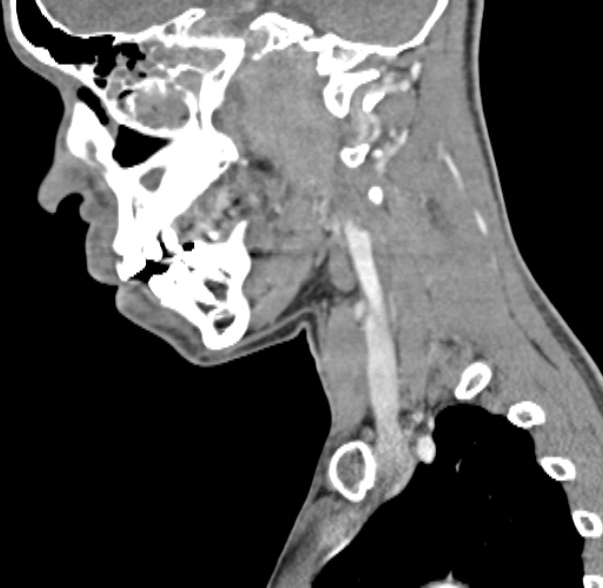 Nasopharyngeal carcinoma with skull base invasion (Radiopaedia 53415-59705 C 47).jpg
