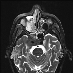 File:Nasopharyngeal carcinoma with skull base invasion (Radiopaedia 59258-66600 D 11).jpg