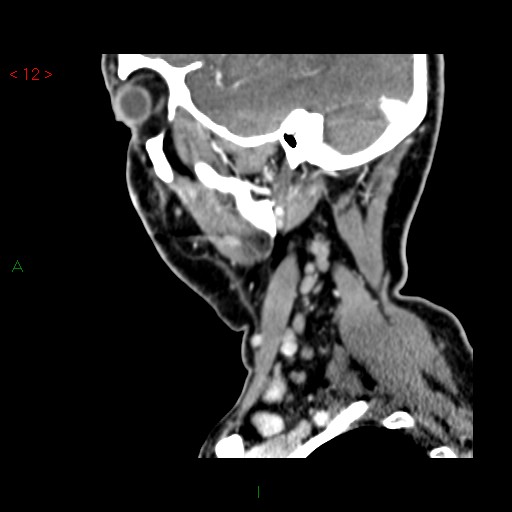 File:Nasopharyngeal lymphoma (Radiopaedia 54235-60432 B 31).jpg
