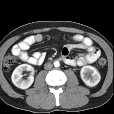 File:Necrotizing pancreatitis with acute necrotic collection (Radiopaedia 14470-14417 B 26).jpg